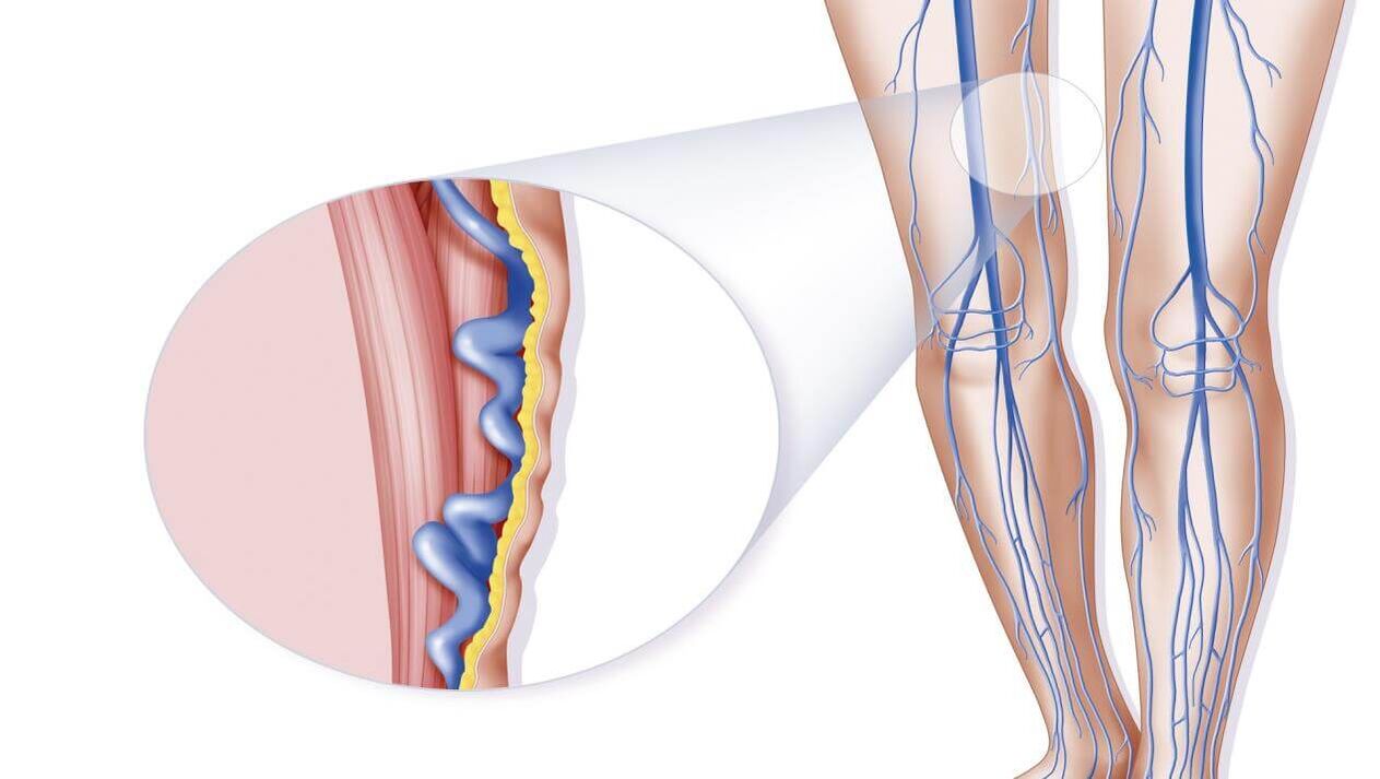 Varikozu vēnu cēloņi